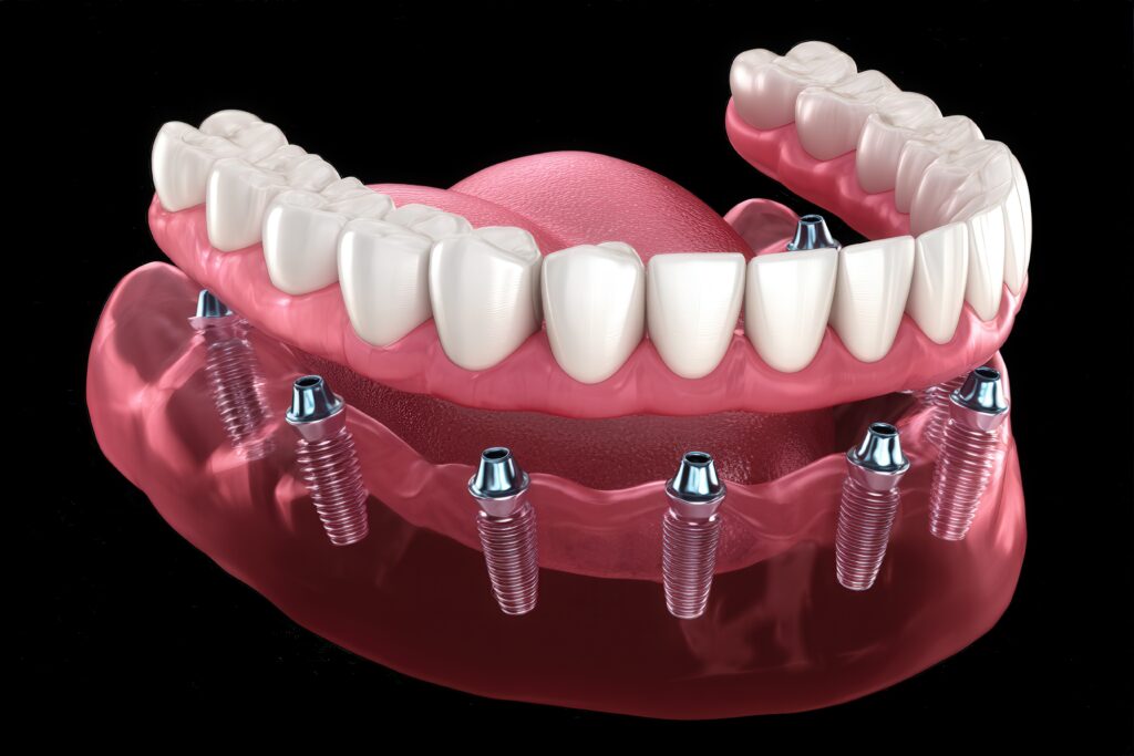 3D illustration of full arch dental implants supporting upper and lower dentures on a jaw model against a black background.