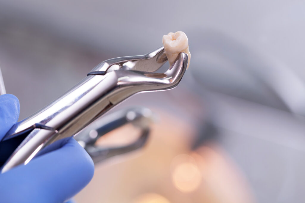 Dental equipment holding an extracted tooth at Global Smiles Dental in Indianapolis
